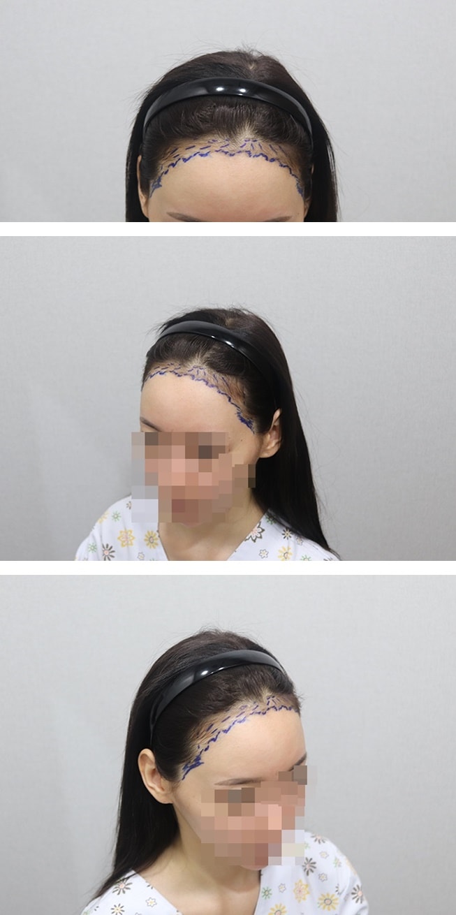 モプラス ヘアライン 1年 レビュー