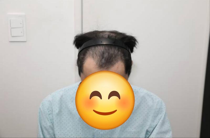 뉴헤어 서울점 절개모발이식 2000모낭 6개월차 후기