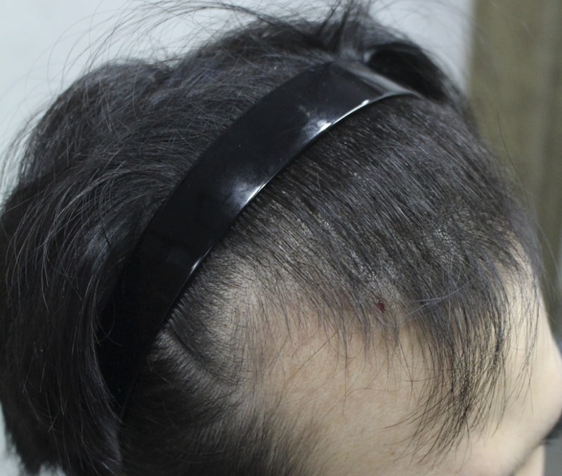 이식후4.jpg
