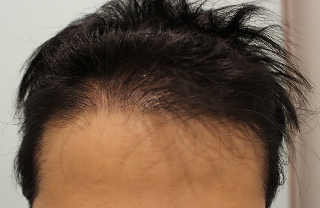 수술후 3개월 1.JPG
