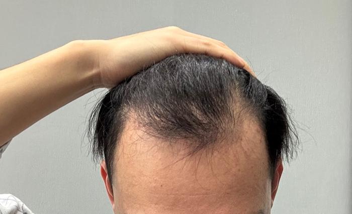 모플러스성형외과 모발이식 비절개 4500모 +188일차 후기