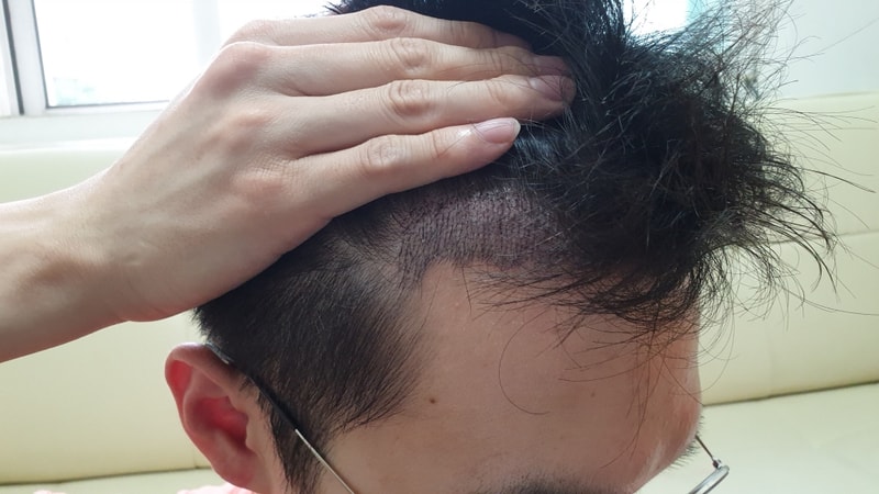 03.최성빈_수술15일.jpg