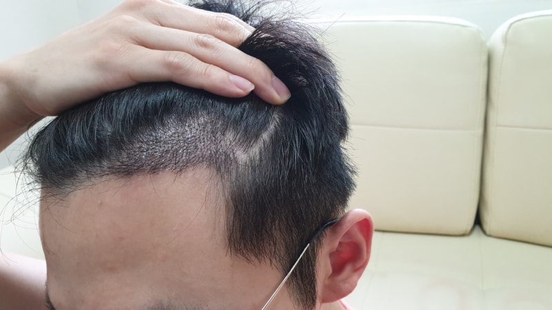 04.최성빈_수술15일.jpg