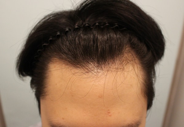 I got 2,400 hair implanted.