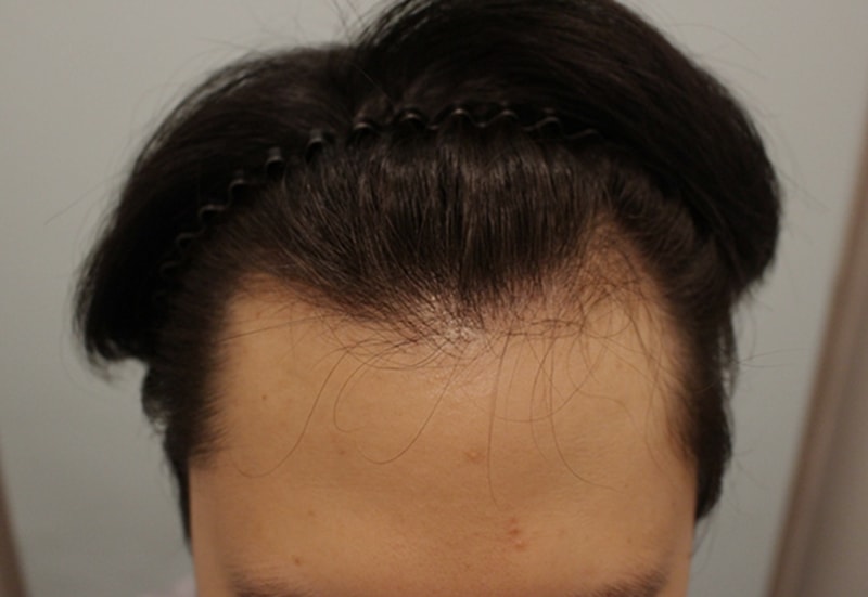 M-shaped/asymmetric line 2400 mother 2 weeks