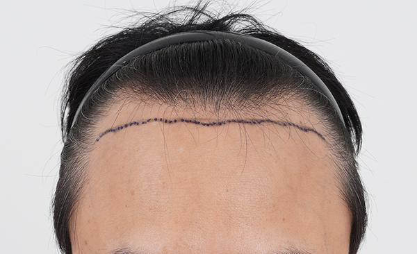 手術前と10ヶ月の比較写真をアップします。