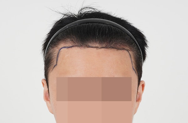 비절개 2000모 이식 1년 경과 후기