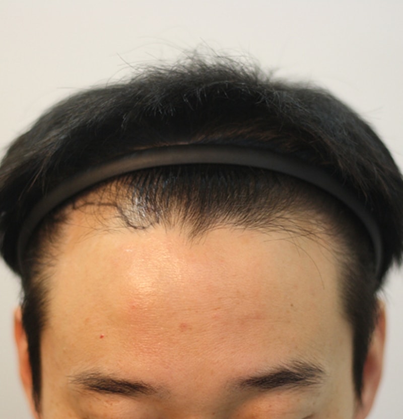 수술전앞.jpg