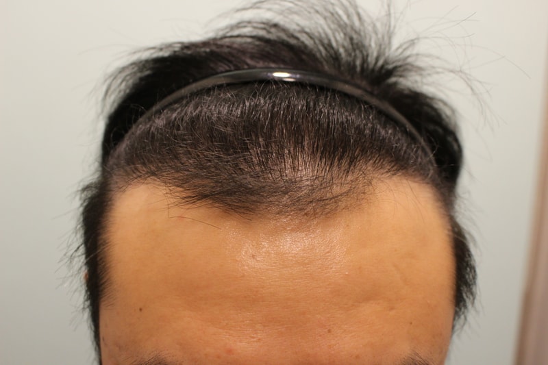 수술후 7개월 2.JPG