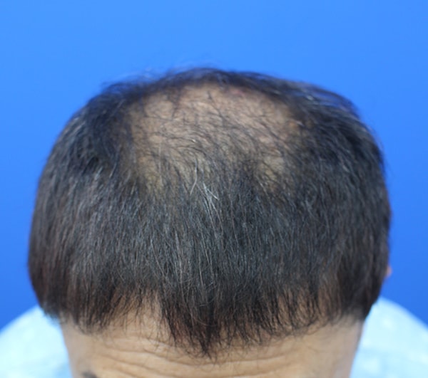 비어가는 정수리에 3200모 이식 받았습니다.