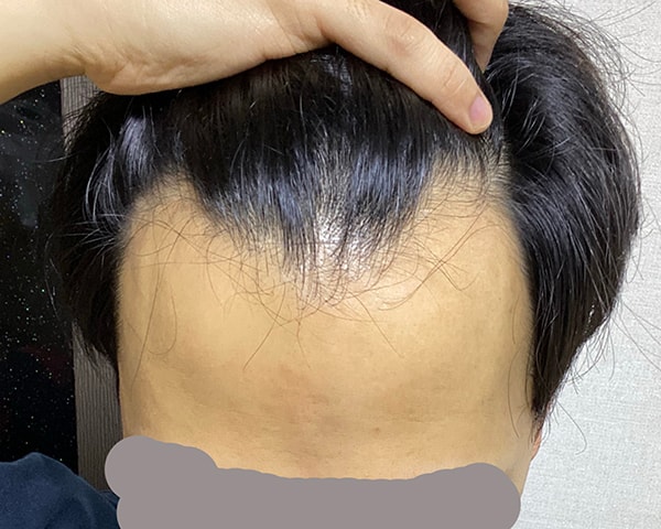 毛髪移植の8ヶ月レビューを残します。
