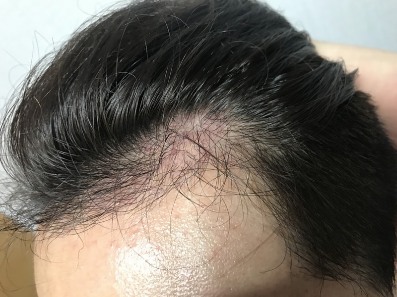 無削足費切開で5ヵ月間満たしました
