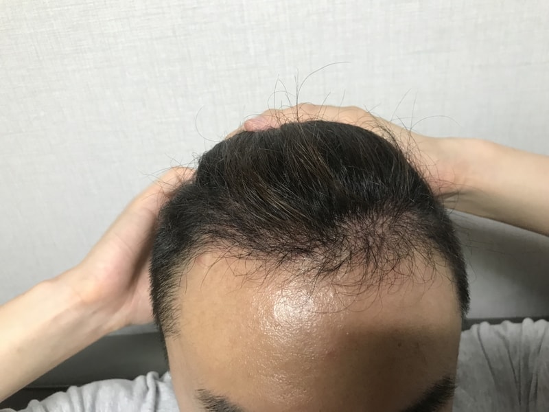無削髪費切りが6ヶ月になりました