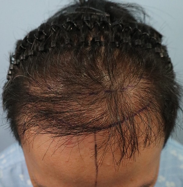 Review of Non-Cutting 3600 Hair Transplantation
