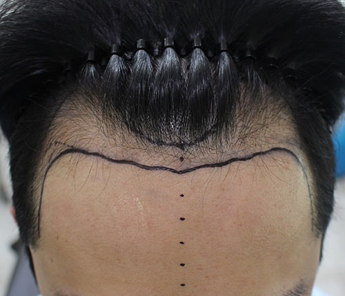 Hannaive hair transplant M-shaped 3700 mother 6 months later