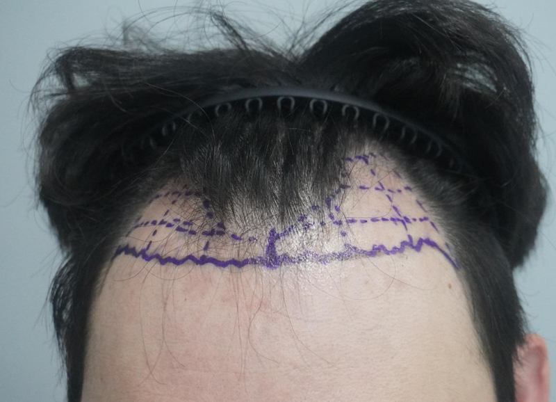 グロウ医院(旧ニューヘア釜山) チャン·テホ院長 M字碑切開 3000毛 1年目の後期