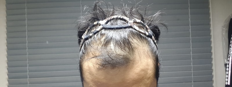 3000모낭 1년3개월 다나성형외과 후기