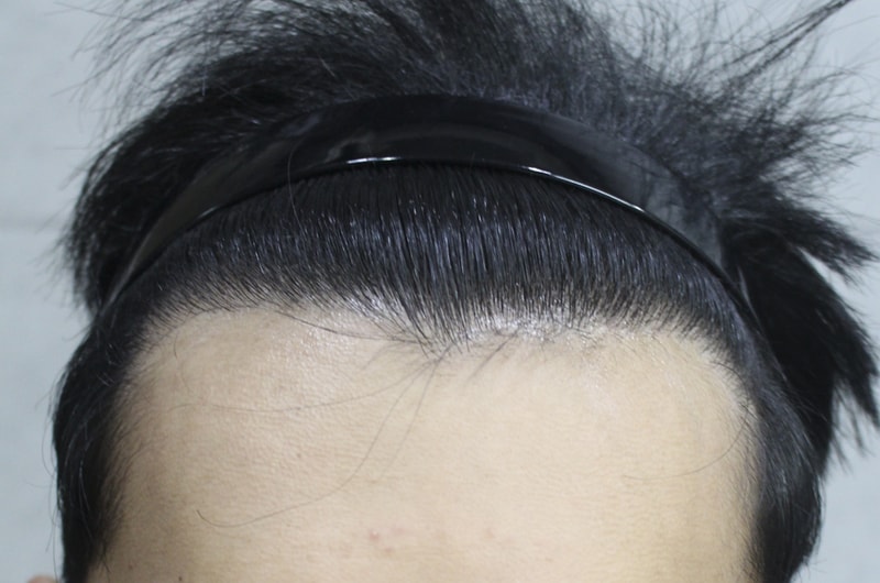 M-shaped incision, 3100 mo, 8 months old