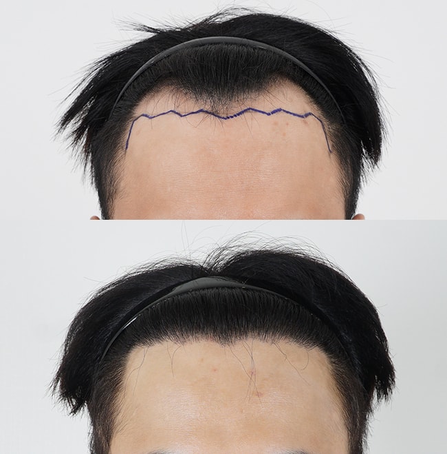 M자 비절개 3600모 수술하고 10개월 결과 나오네요