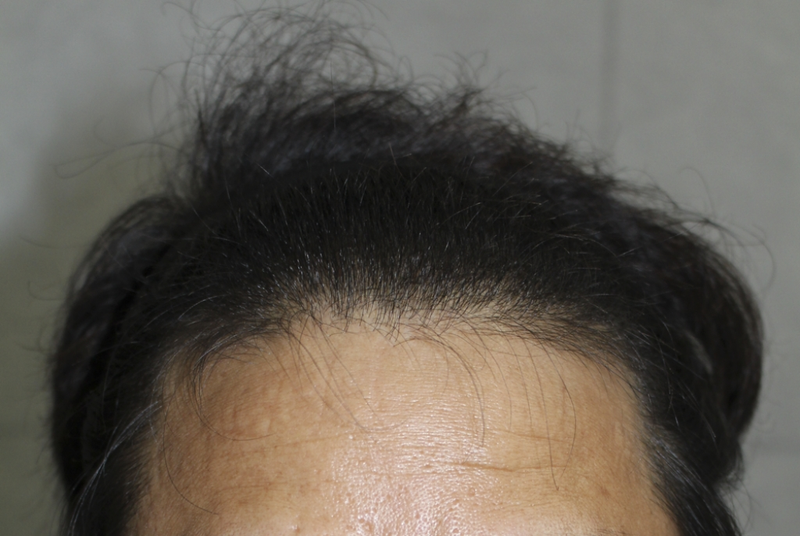 髪の毛がよく伸びたか一度見てください（切開9ヶ月）
