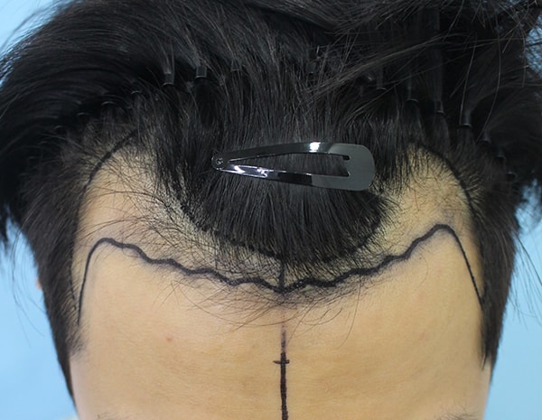 I received an M-shaped transplant. (3000 hair incision)
