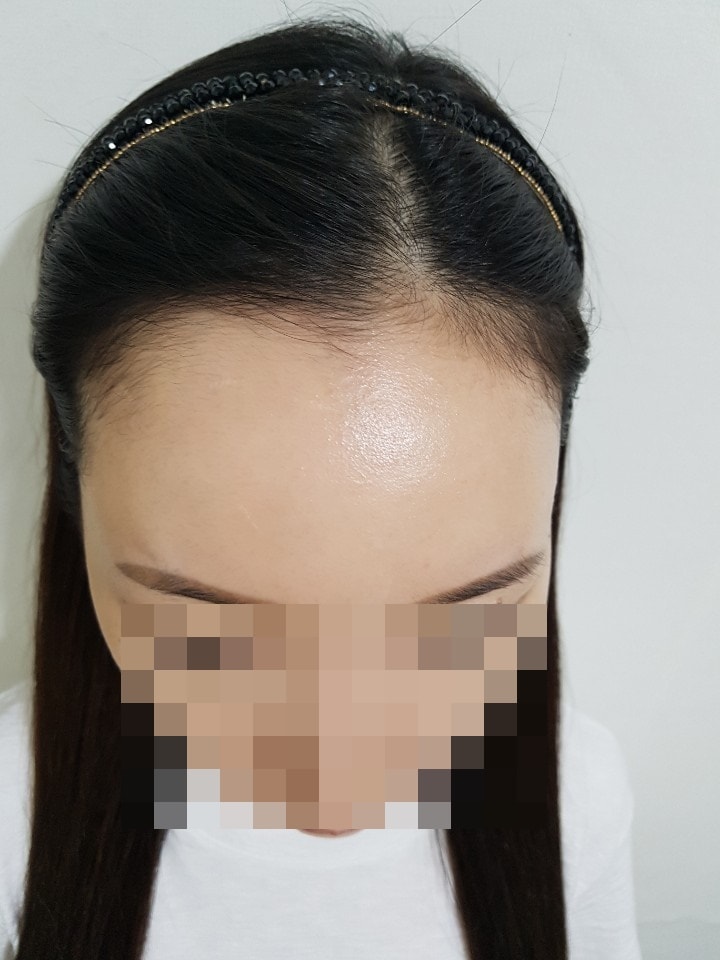 ヘアライン二ヶ月目のレビュー