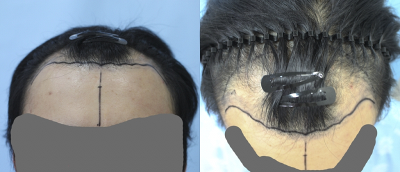I'm in my first year of 3500-mo implantation