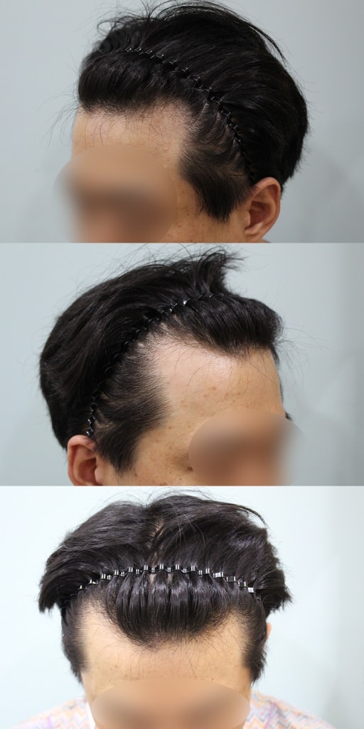 나수술전.jpg