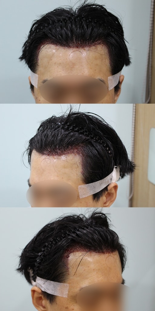 수술후.jpg