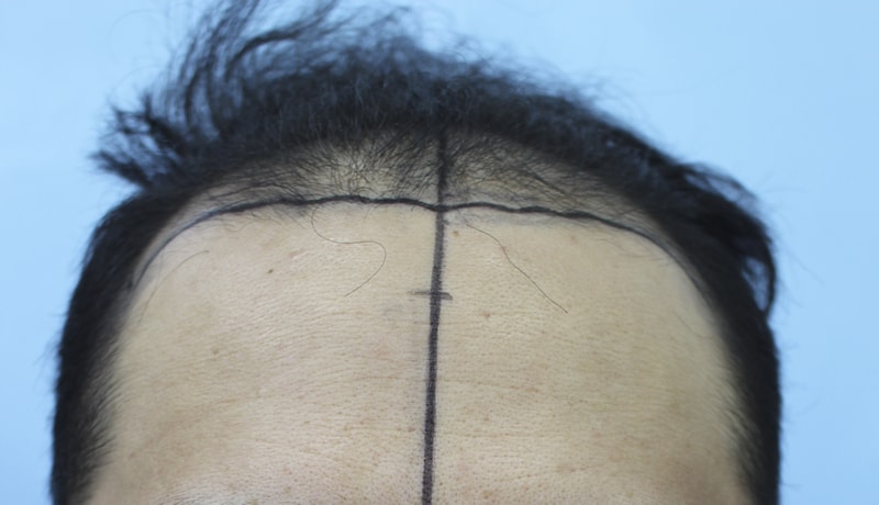 I'm so satisfied with the 4th month of transplantation