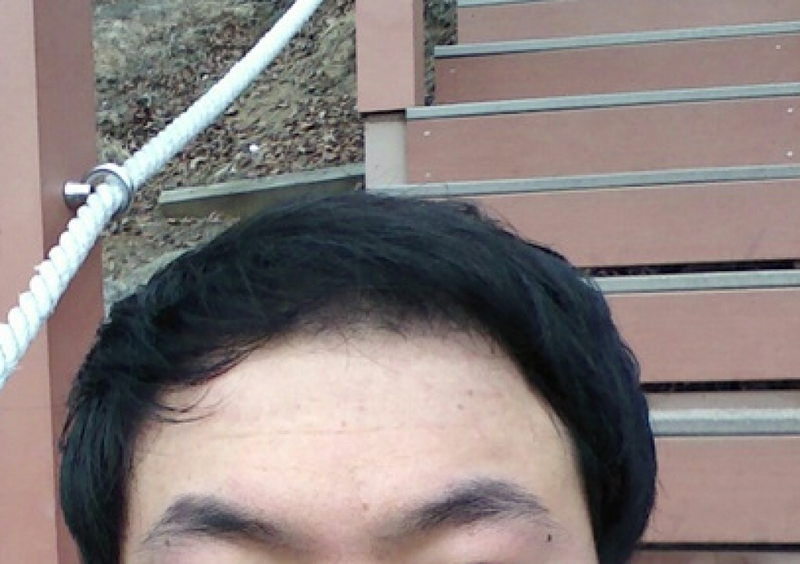 수술후3개월셀카.png
