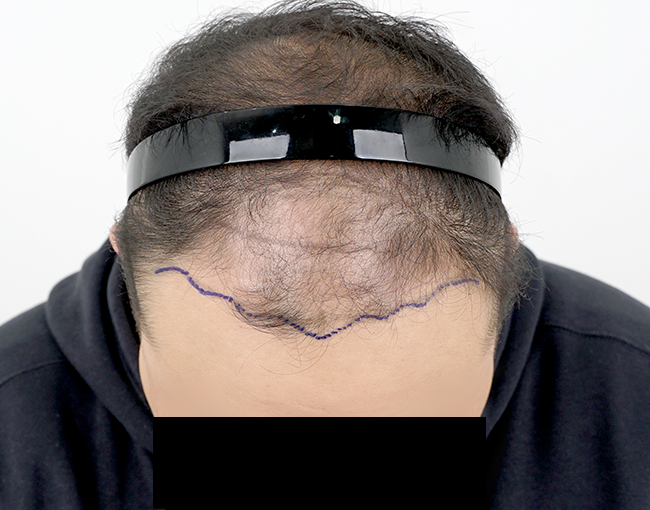 수원 탈모병원 모모 문효섭원장님 강력 추천합니다.(수술 1년 결과 만족합니다)