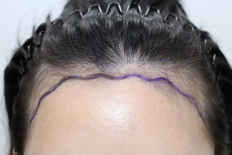 Daegu Forehead Hairline Correction Non-Sectional Hair Transplantation in the 1st Month of Dark Age