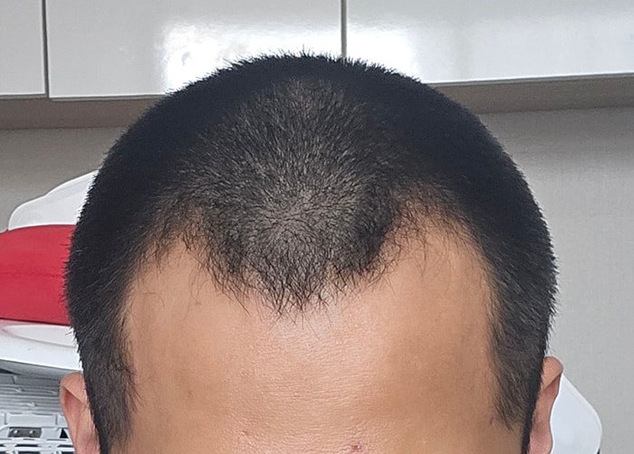 모플러스 성형외과 M자 비절개 2600모 모발이식 2주 후기
