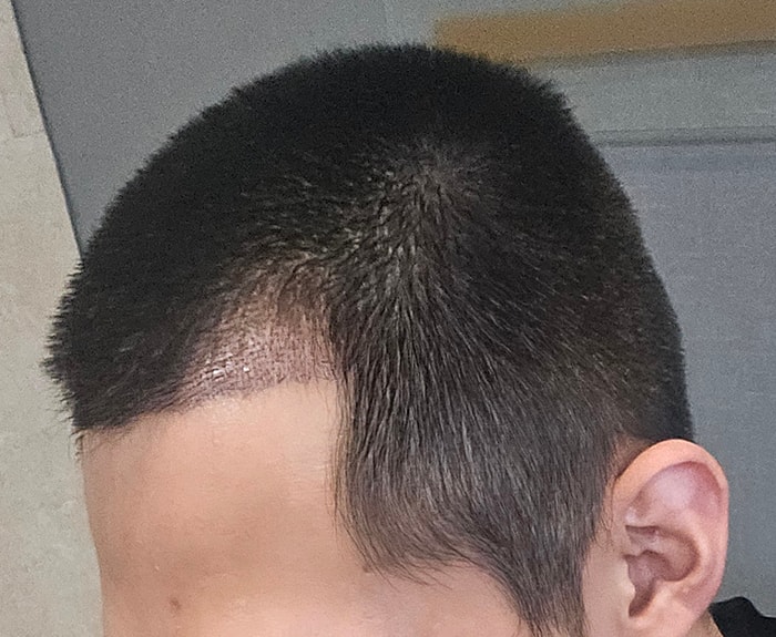 5. 수술2주.jpg