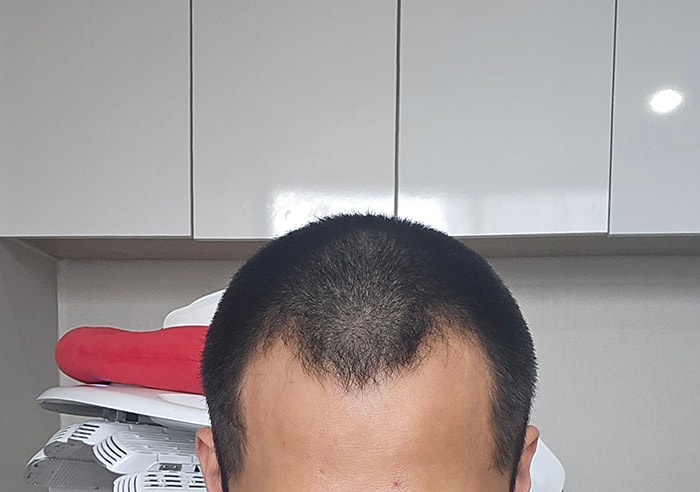 모플러스 성형외과 M자 비절개 2600모 모발이식 후기