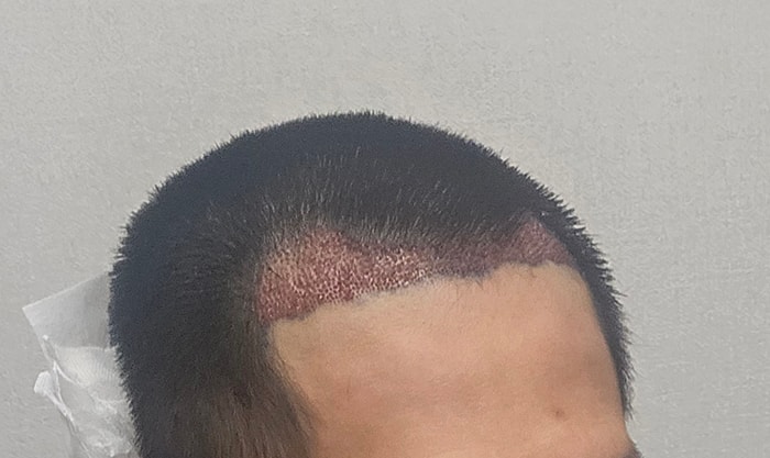 7. 수술직후 측면2.jpg