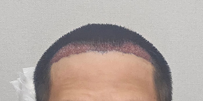 4. 수술직후.jpg