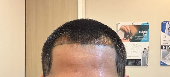 8.수술다음날 샴푸받고.jpg