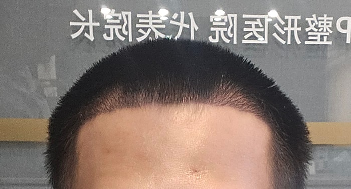 3. 수술2주.jpg
