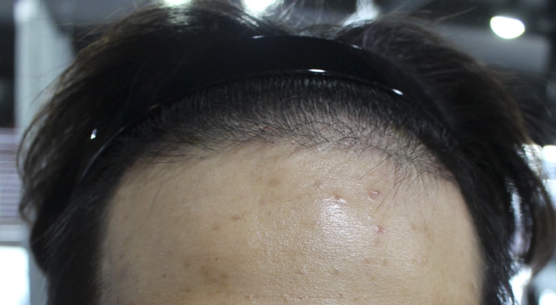 ヘアライン移植の3ヶ月レビューを残してみます