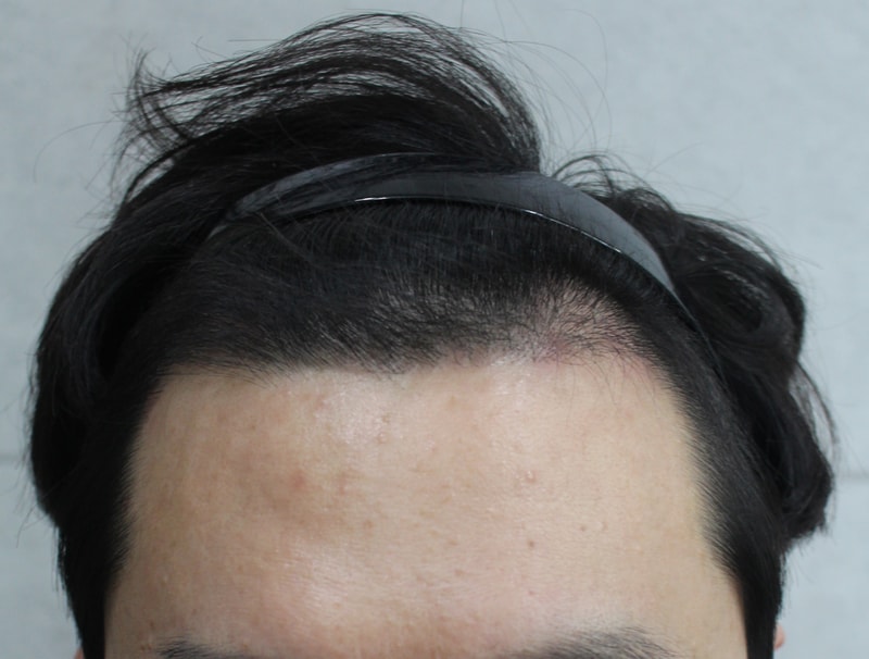 3 months picture of incision M-shaped 2900 hair transplant