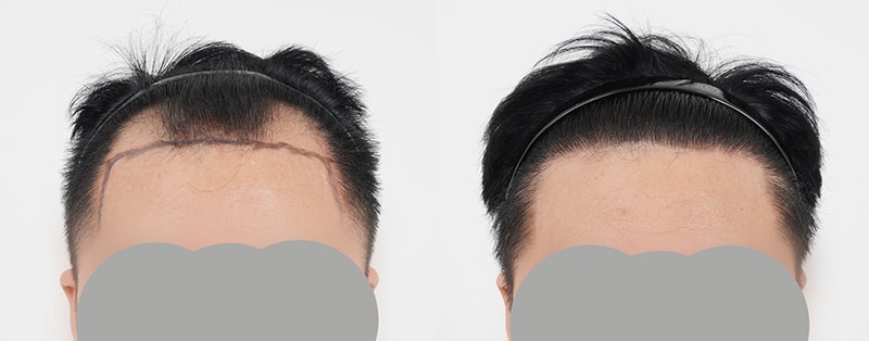 M자 탈모로 비절개 3200모 이식받고 1년 최종 후기