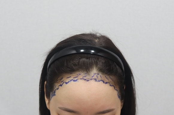 ヘアライン5ヶ月の密度が たくさん上がってきました