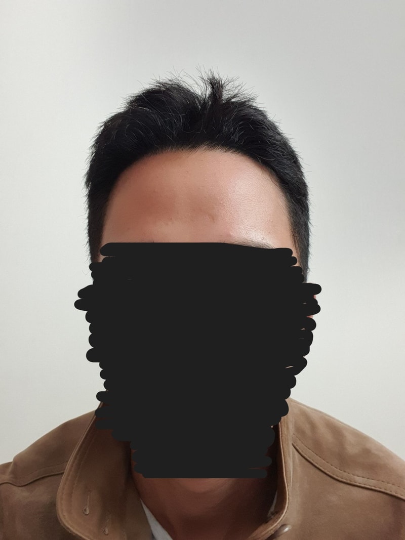 Dana是第15个月的EMZA毛发移植后记