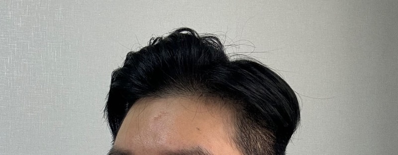 Dana's shaved Emza hair transplant is 14 months old