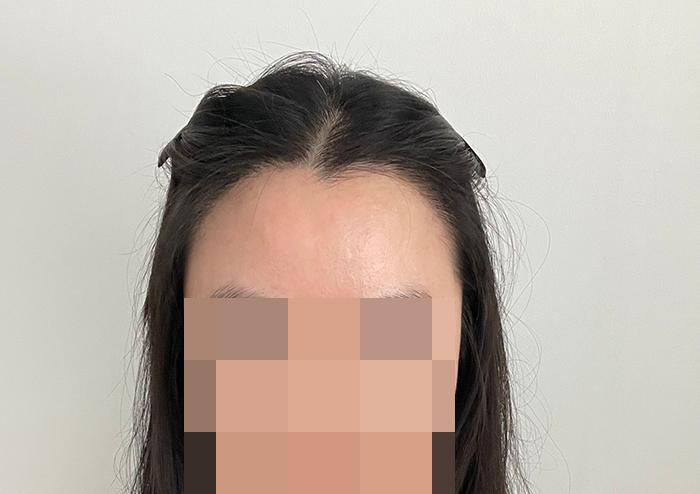[모플러스 성형외과] 헤어라인교정 비절개 2000모 149일차 후기!