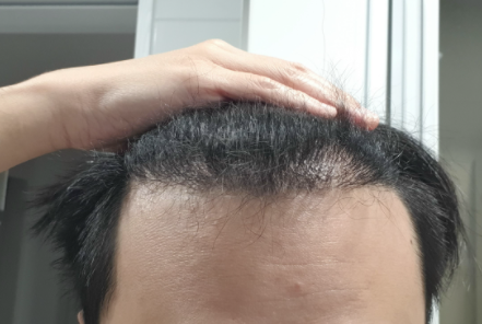 New hair non-cut 1600 hair follicles (3200 hair) Day 200 (6 months and 14 days)