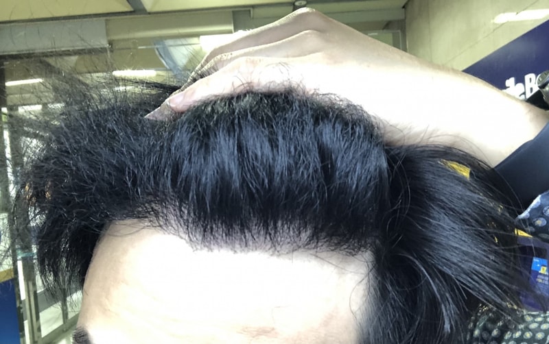 (Each hair curlyㅠ) New hair non-cut 1600 hair follicles 287 days elapsed (9 months and 13 days)