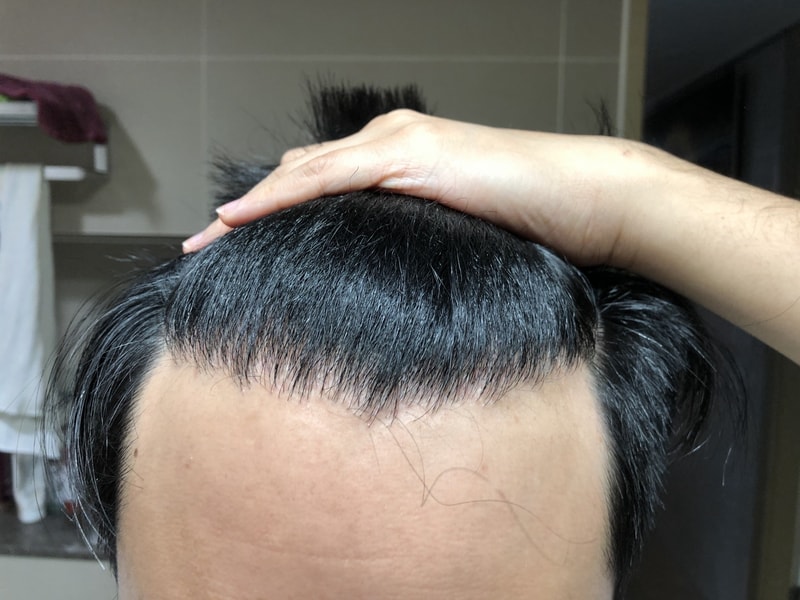 New Hair Non-Cutting 1600 Hair follicles 332 Days After (10 months and 27 days)